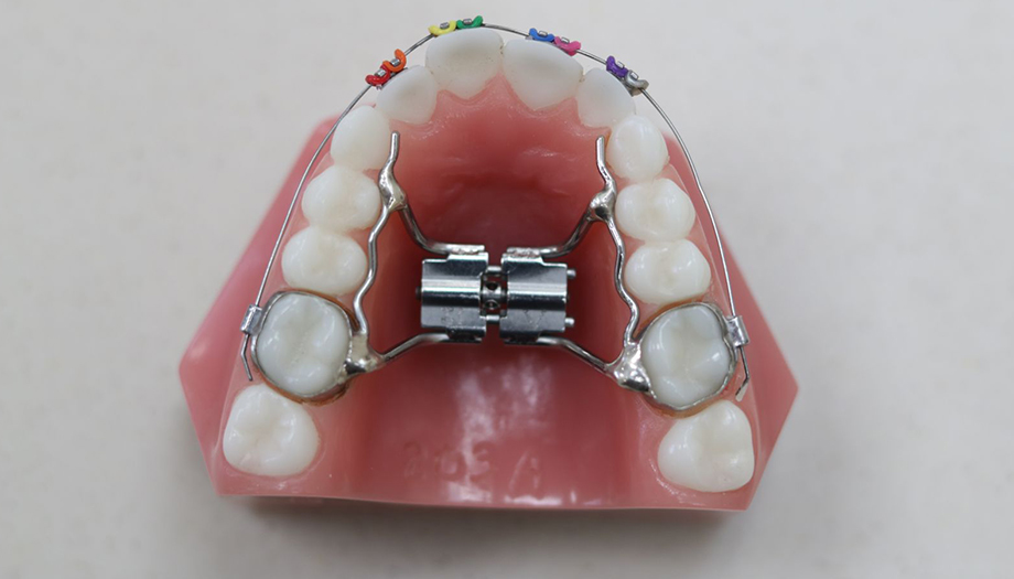 Orthodontic Appliances | Orthodontics in Coorparoo | EDGE Orthodontics